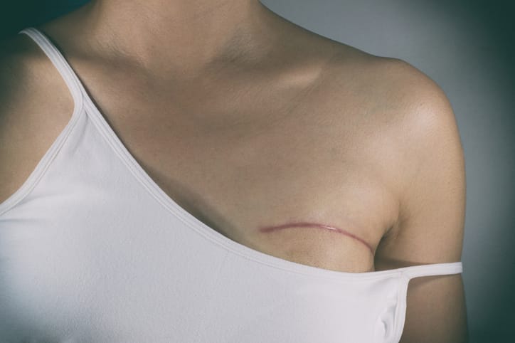 Photo shows a woman displaying her mastectomy scar/Getty Images