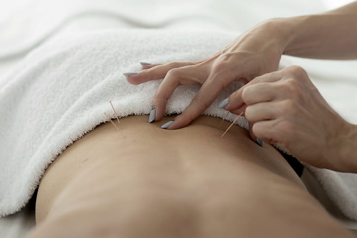 Photo shows a patient receiving acupuncture/Getty Images